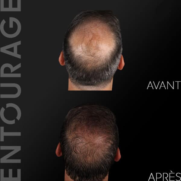 Avant/Après greffe de cheveux FUT