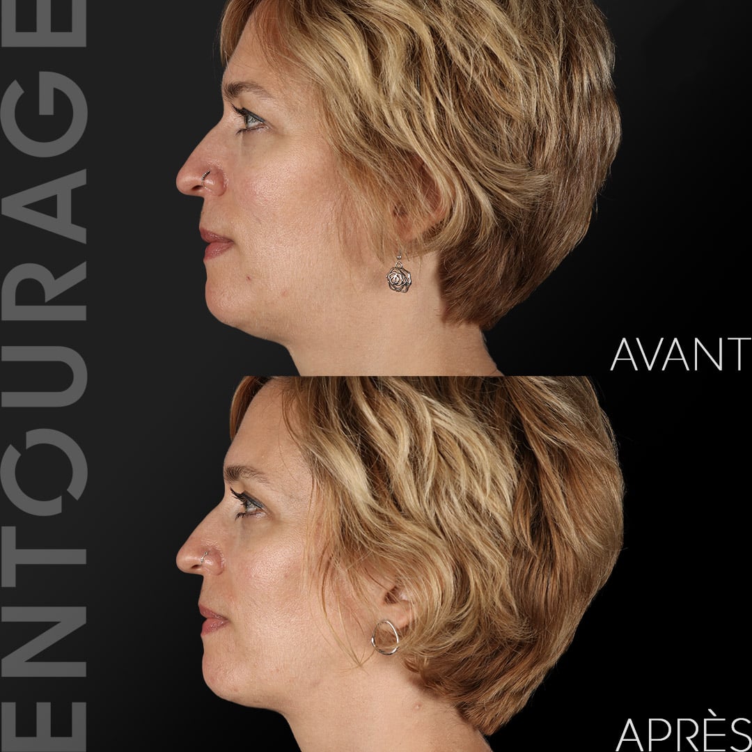 Avant/Après Liposuccion double menton
