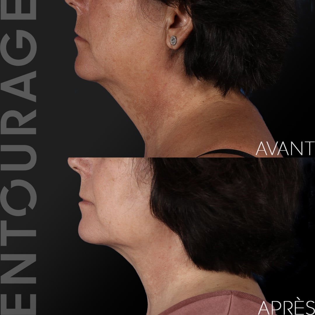 Avant/Après Liposuccion cou Lausanne