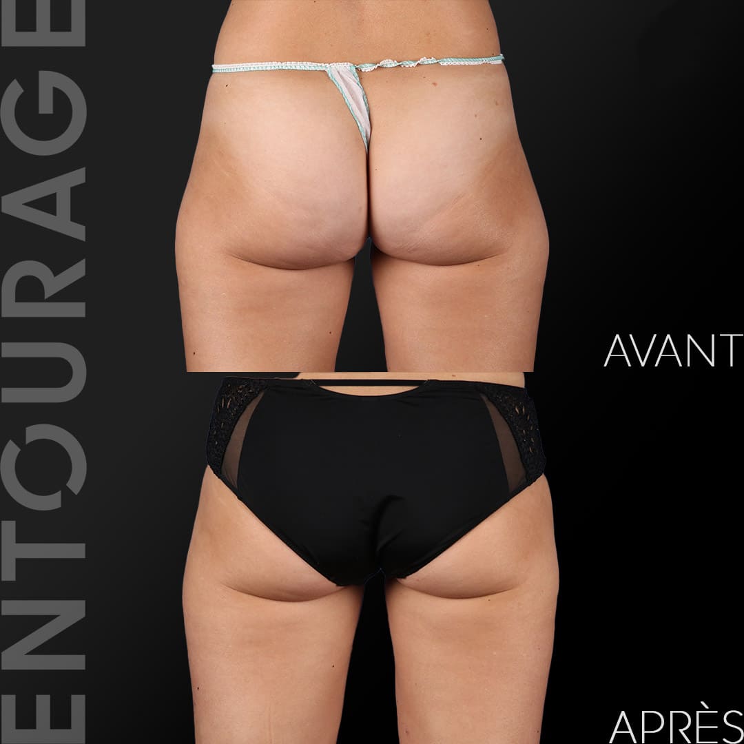 Avant/Après culotte de cheval