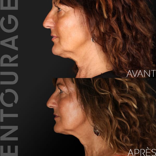 Avant/Après Morpheus 8 visage