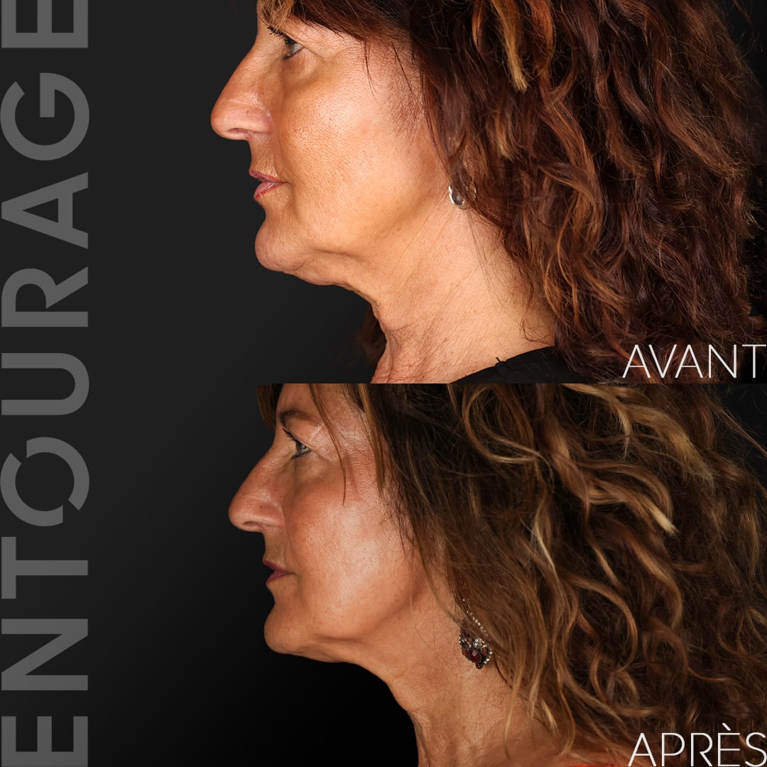 Avant/Après Morpheus 8 visage