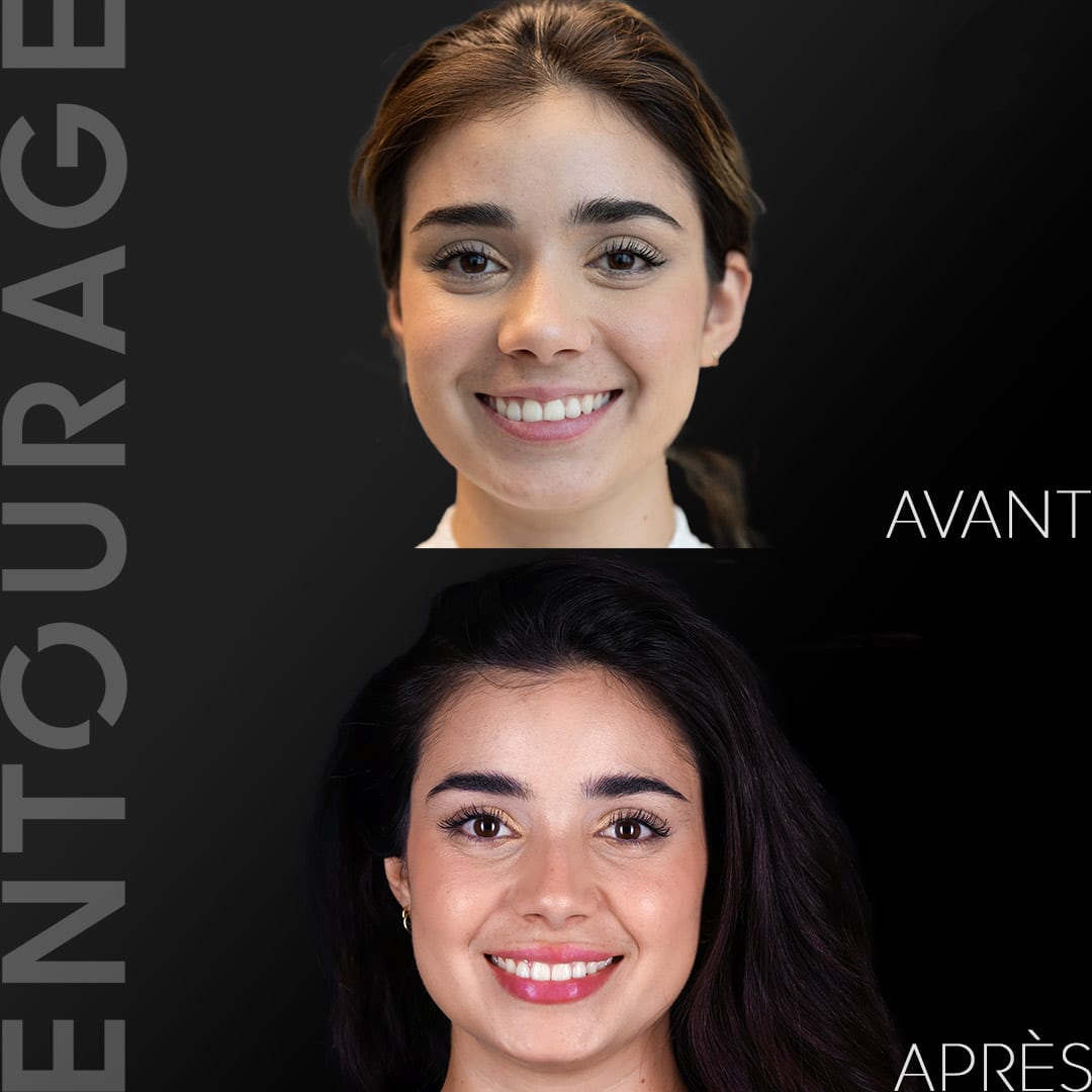 Avant/après injection AH lèvres
