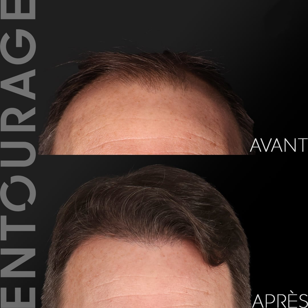Avant/après greffe de cheveux Lausanne