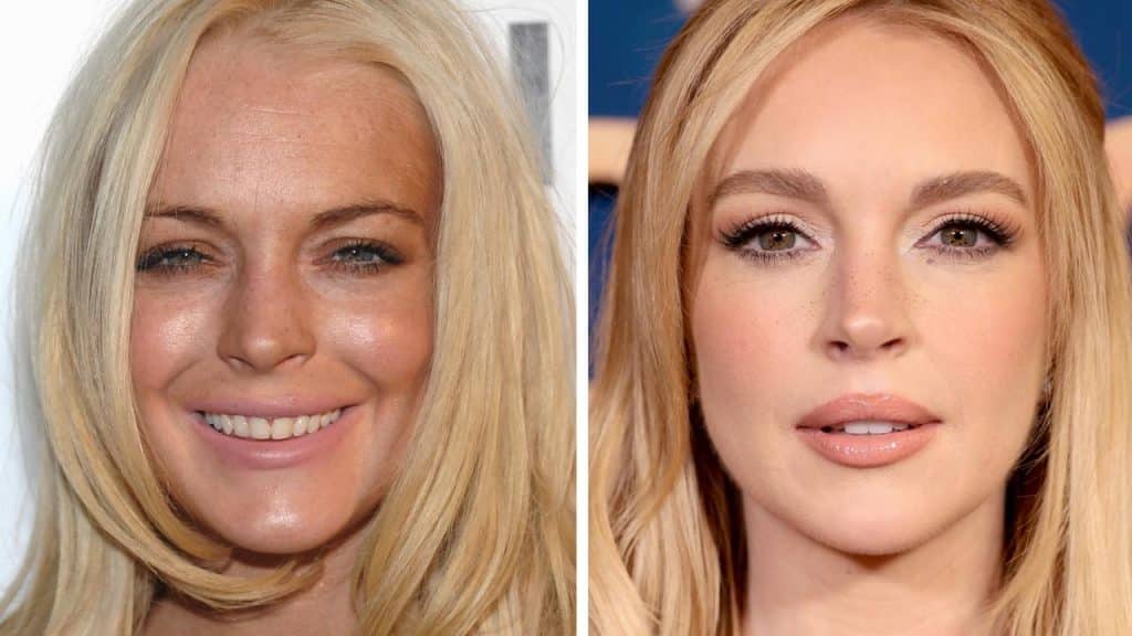 Face lift changes natural expressions?