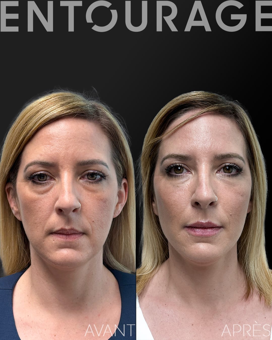 Injections d'acide hyaluronique à Lausanne visage