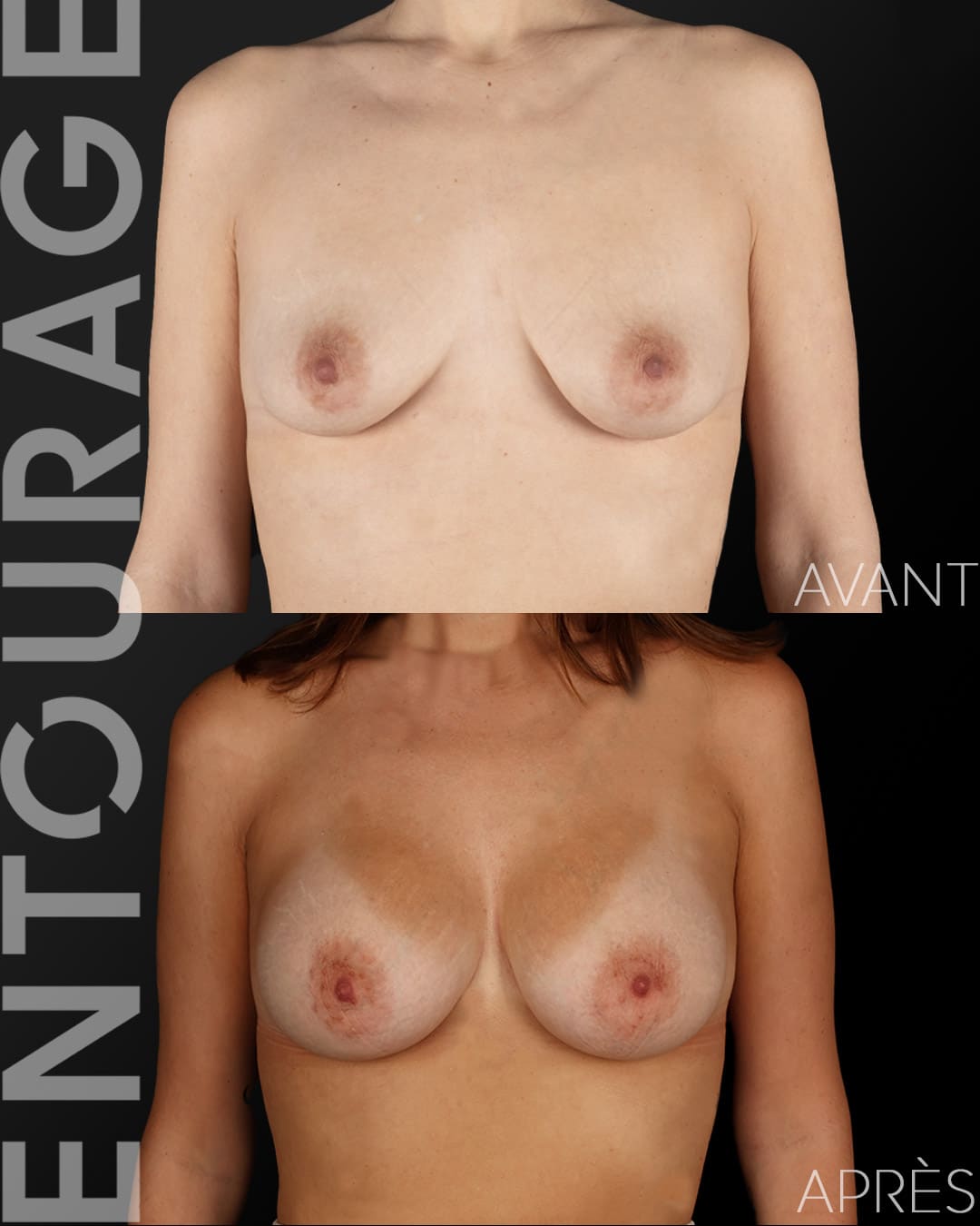 Implants Motiva avant-après