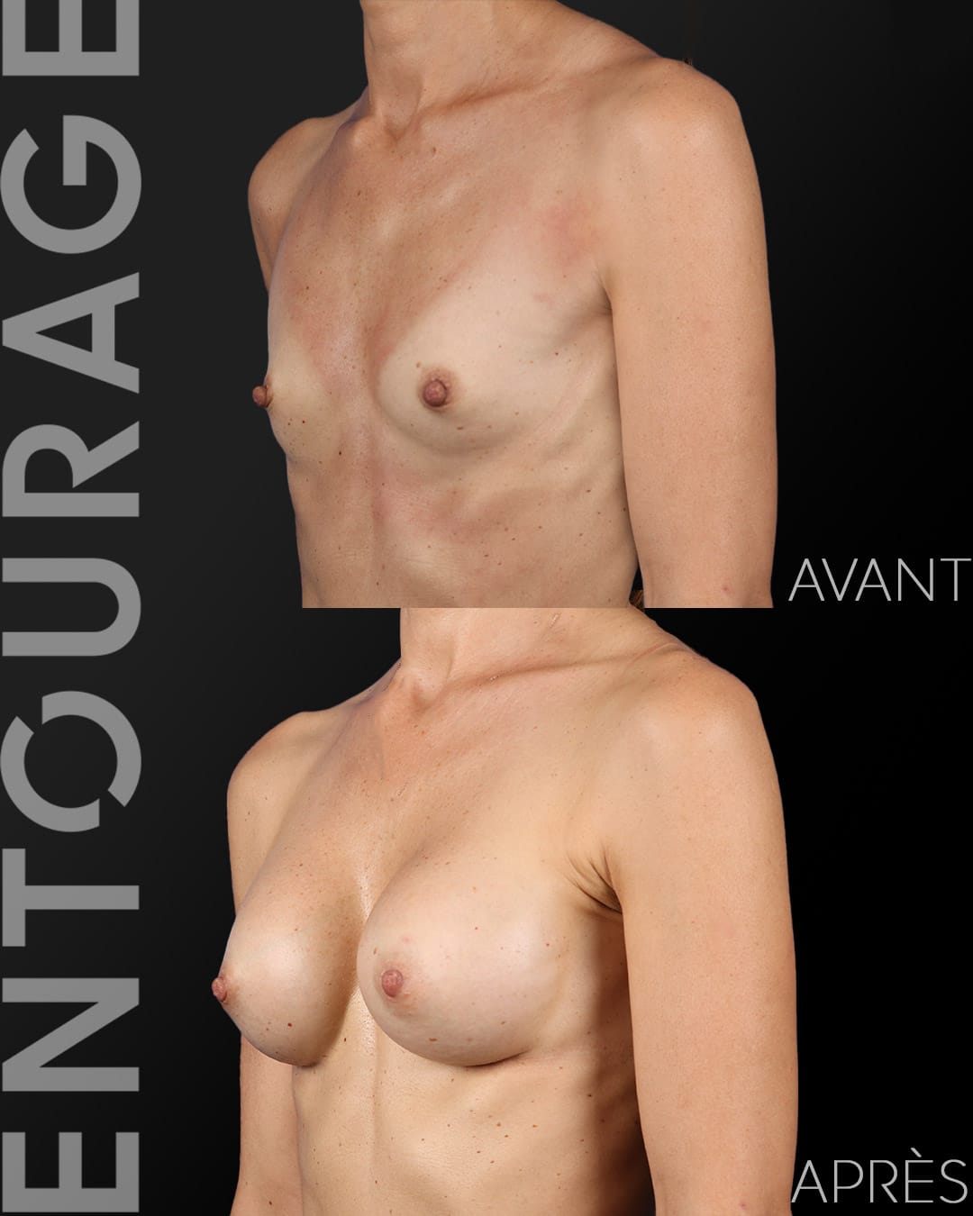 Augmentation mammaire à Lausanne